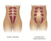 Protruding belly after pregnancy - diastasis recti